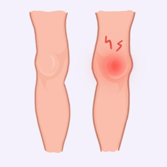 膝盖疼、腿疼、脚疼……5种跑步损伤，专家教你处理！